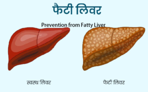 Fatty Liver